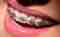 Metal Braketler